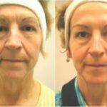 Before and after microcurrent facial treatments.