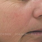 Visible aging client - before.