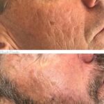 Dermapen micro-needling: acne scar reduction.